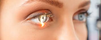 Laser Eye Surgery in Burlington, Ontario